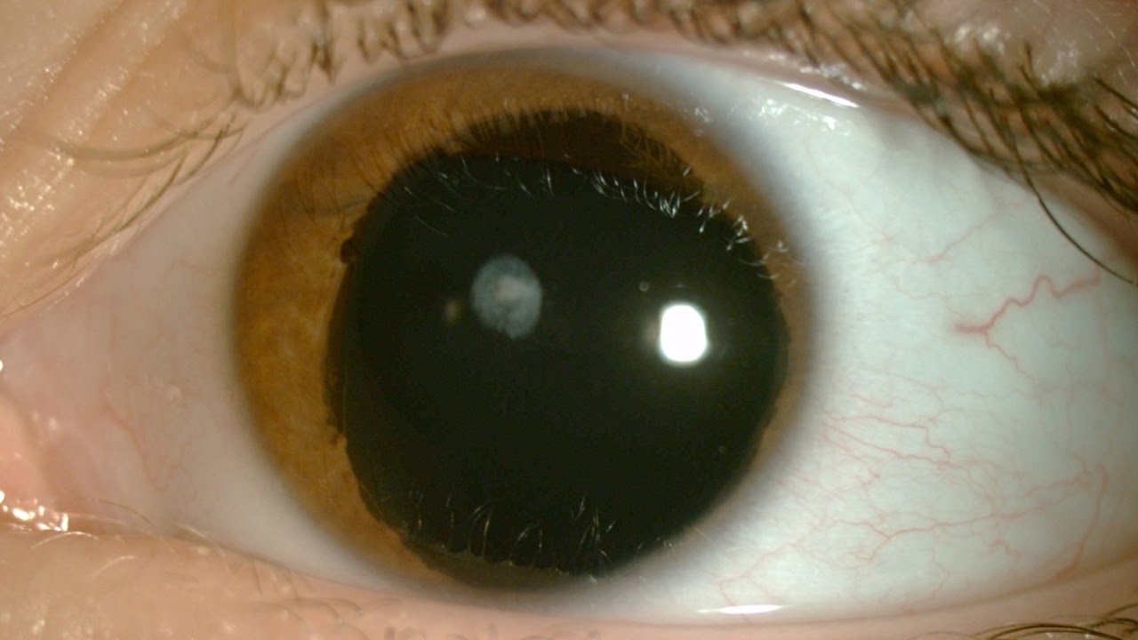 For children facing near-blindness, UBC offers hope for a cure