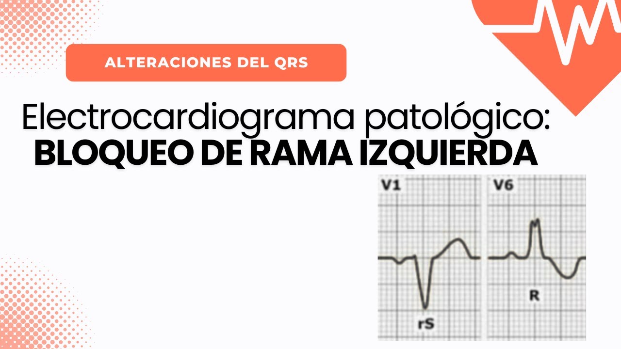 Electrocardiograma Patológico: BLOQUEO DE RAMA IZQUIERDA