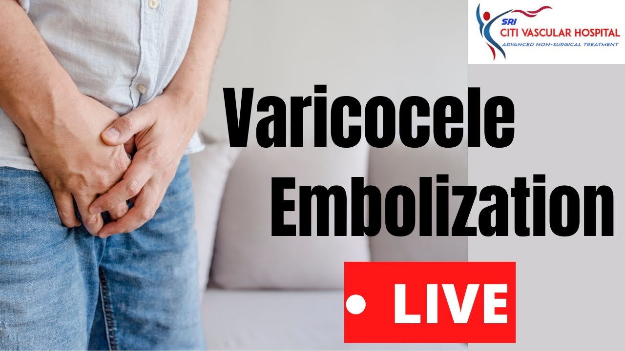 Varicocele | Varicocele Embolization  Live Video in India By Varicocele Expert