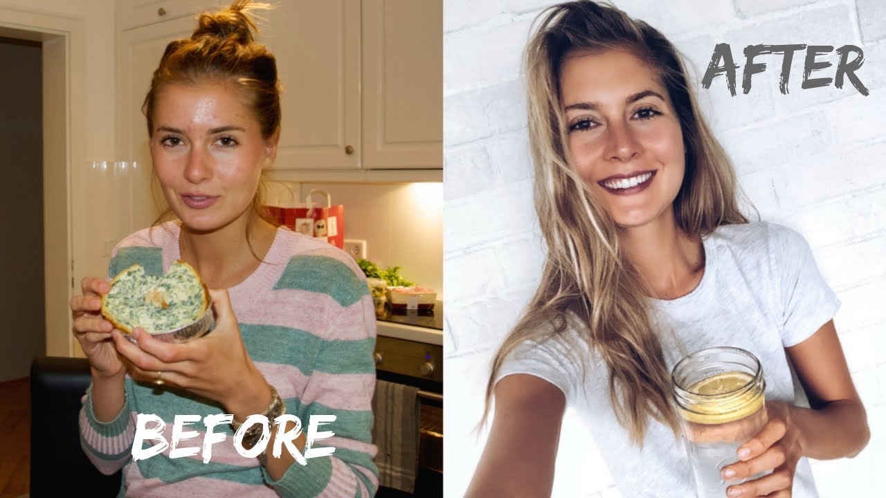 HOW I FINALLY HEALED MY ACNE NATURALLY (birth control, digestion, food)  // EASY TIPS