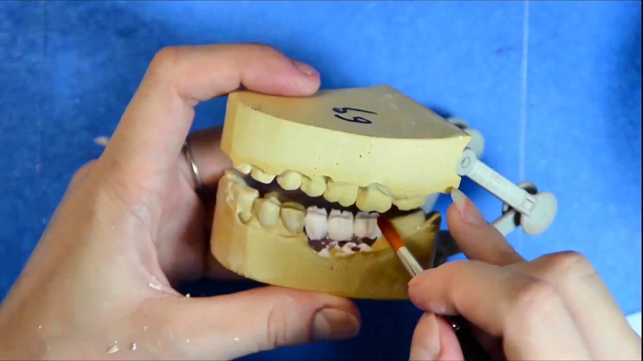 Implant bridge3