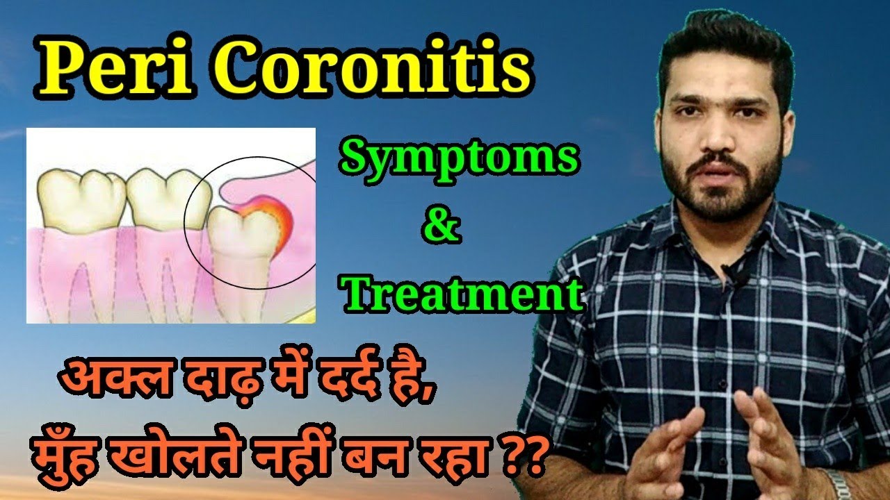 Peri coronitis , symptoms & treatment | अक्ल दाढ़ दर्द का एक कारण !