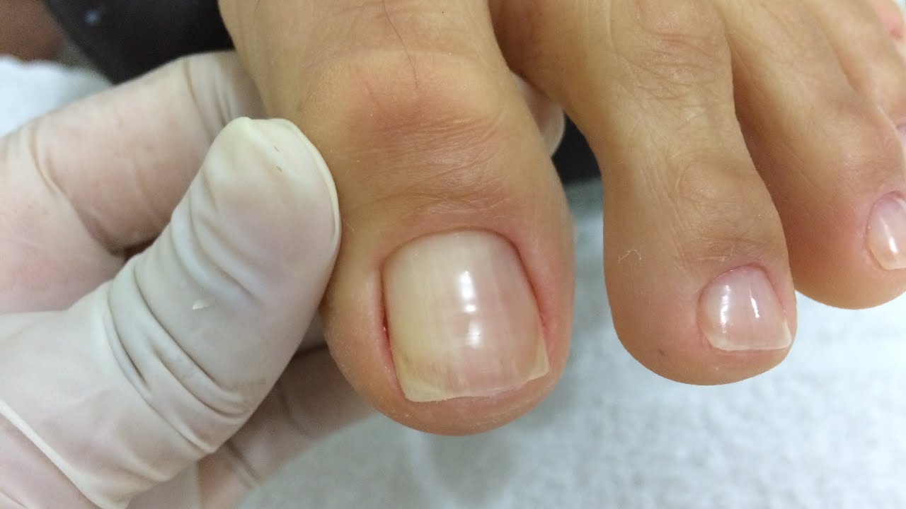 Como faço a remoção da cutícula das unhas do pé