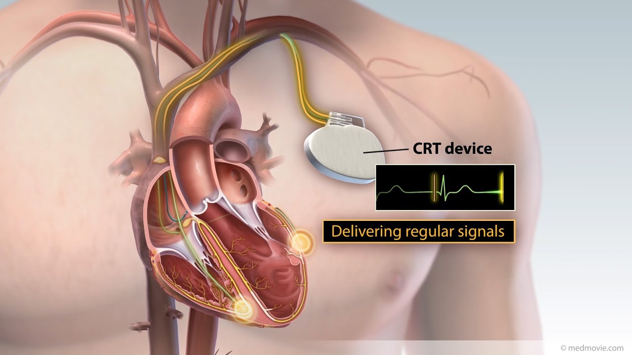 Cardiac Resynchronization Therapy