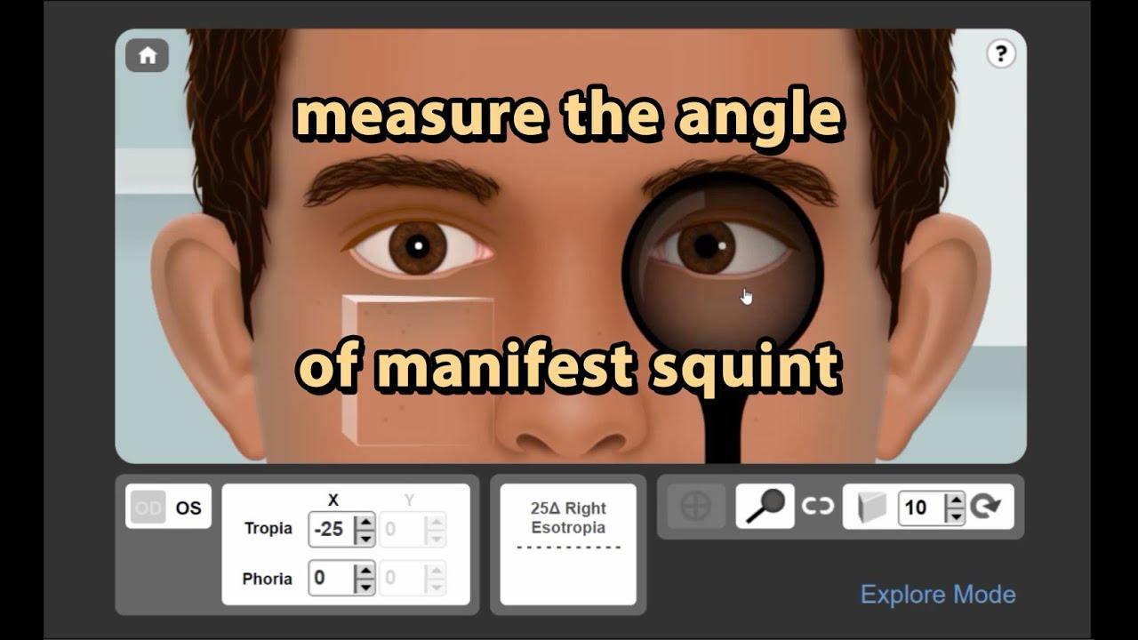 تشخيص وقياس زاوية الحول الظاهر بالبرزم (1) manifest squint