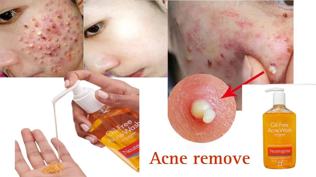 আসল সত্যি টা জানুন ||Neutrogena Oil-Free Acne Wash|| কেমন এই ফেসওয়াশ টি? khadija begum