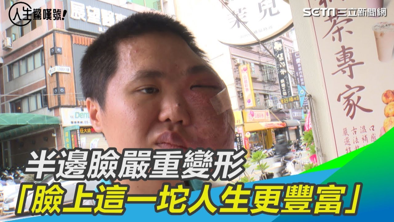 陽光男孩／半邊臉嚴重變形 「臉上這一坨讓我人生更豐富」｜@setn