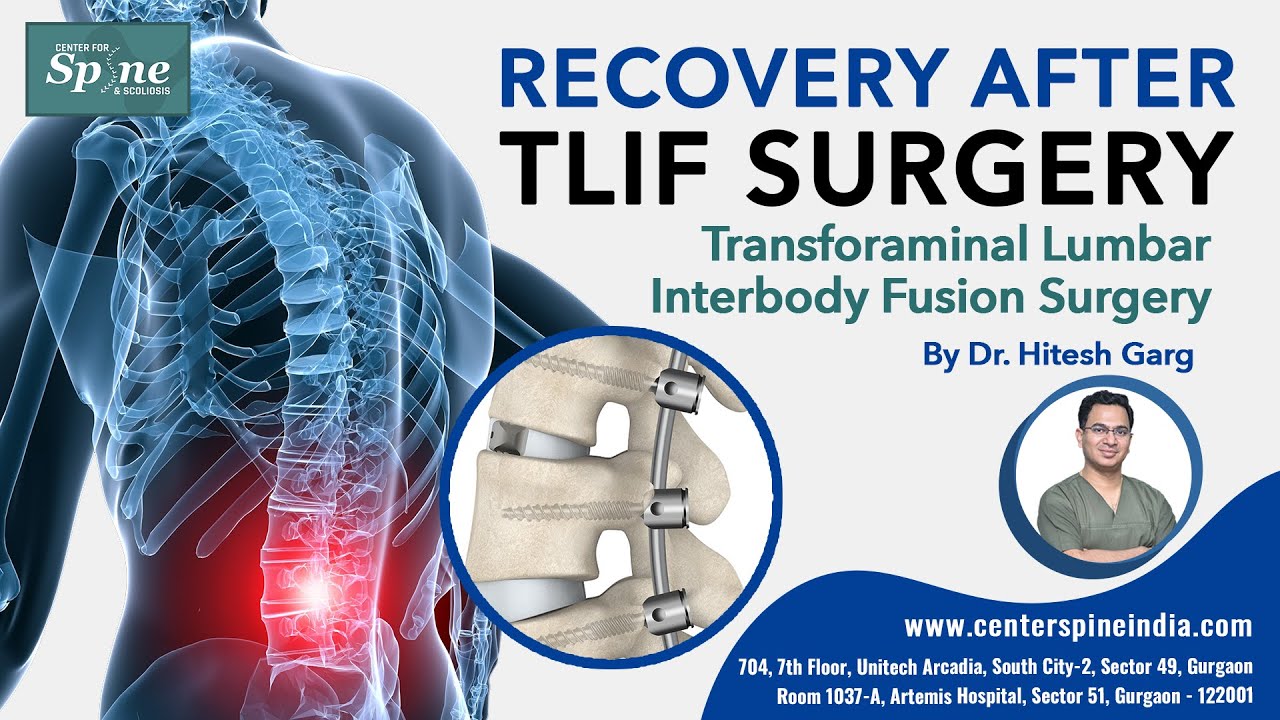 Recovery after TLIF Surgery | Life after Spinal Fusion Surgery | Spinal Surgery Specialist in India