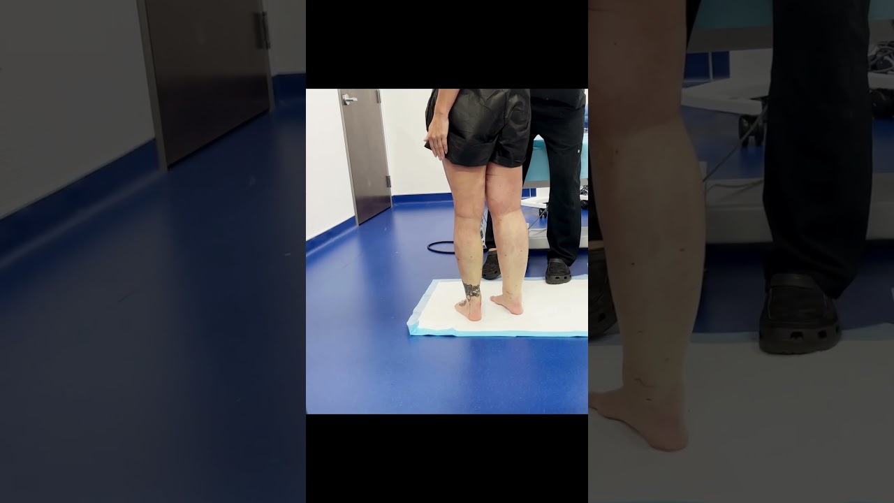 Lipedema Liposuction | 360&deg; Cankle and Knee Surgery | Expert Dr. Thomas Su | Artlipo