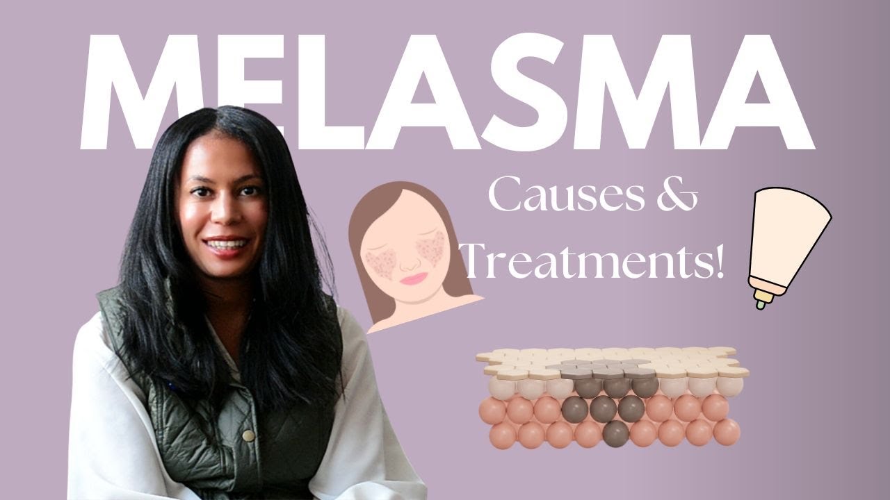 Melasma Causes, Triggers, Prevention & Treatments!