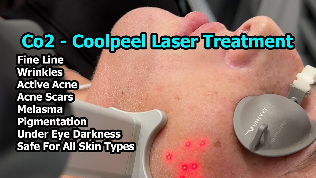 Co2- 'Coolpeel' Laser Treatment: What does it really do?