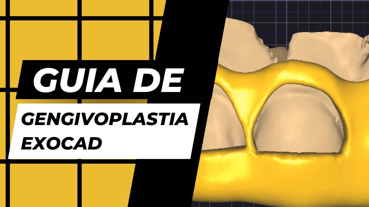 Como fazer guia de Gengivoplastia no software Exocad.