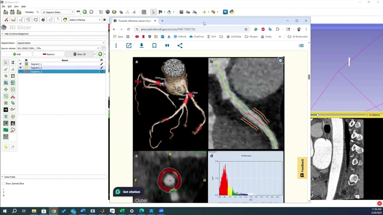 3D Slicer Coronary Segmentation on CT (contrast & non-contrast) for PCAT calculation