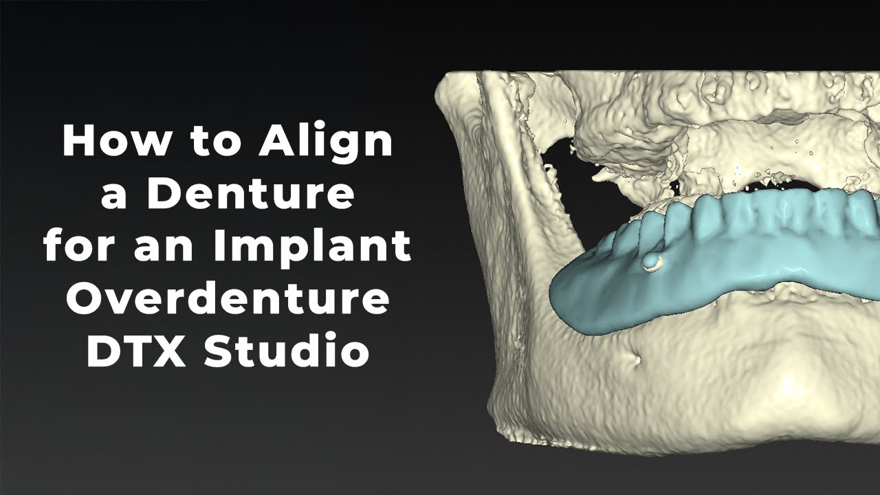 Aligning a CBCT Scan of a Denture in DTX Studio for Implant Overdenture Planning