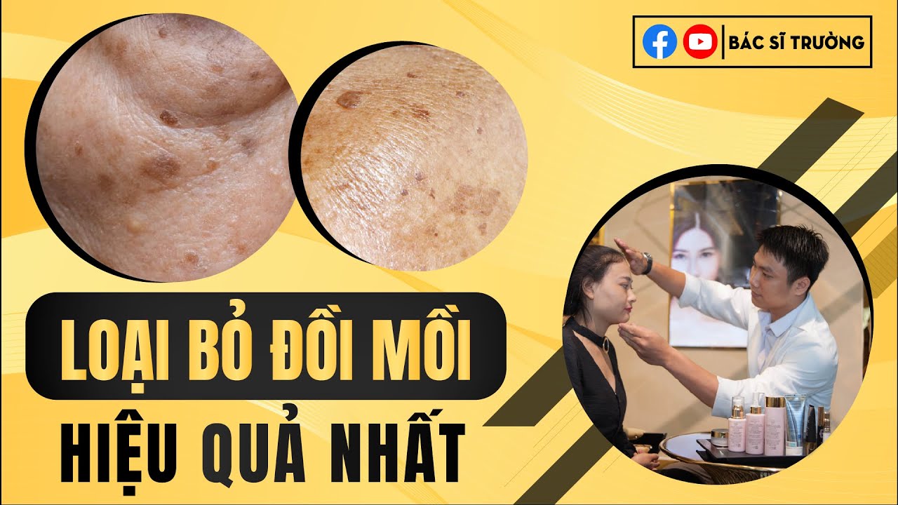 Cách trị đồi mồi đốm nâu ở mặt, tay | Bác sĩ Trường