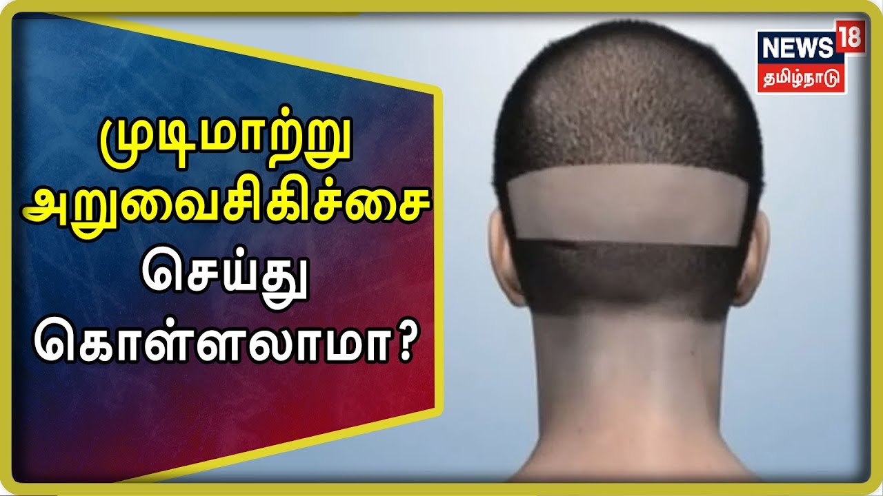 Kelvigal Aayiram: வழுக்கை விழுந்தவர்கள் முடிமாற்று அறுவைசிகிச்சை செய்து கொள்ளலாமா? | Hair Transplant