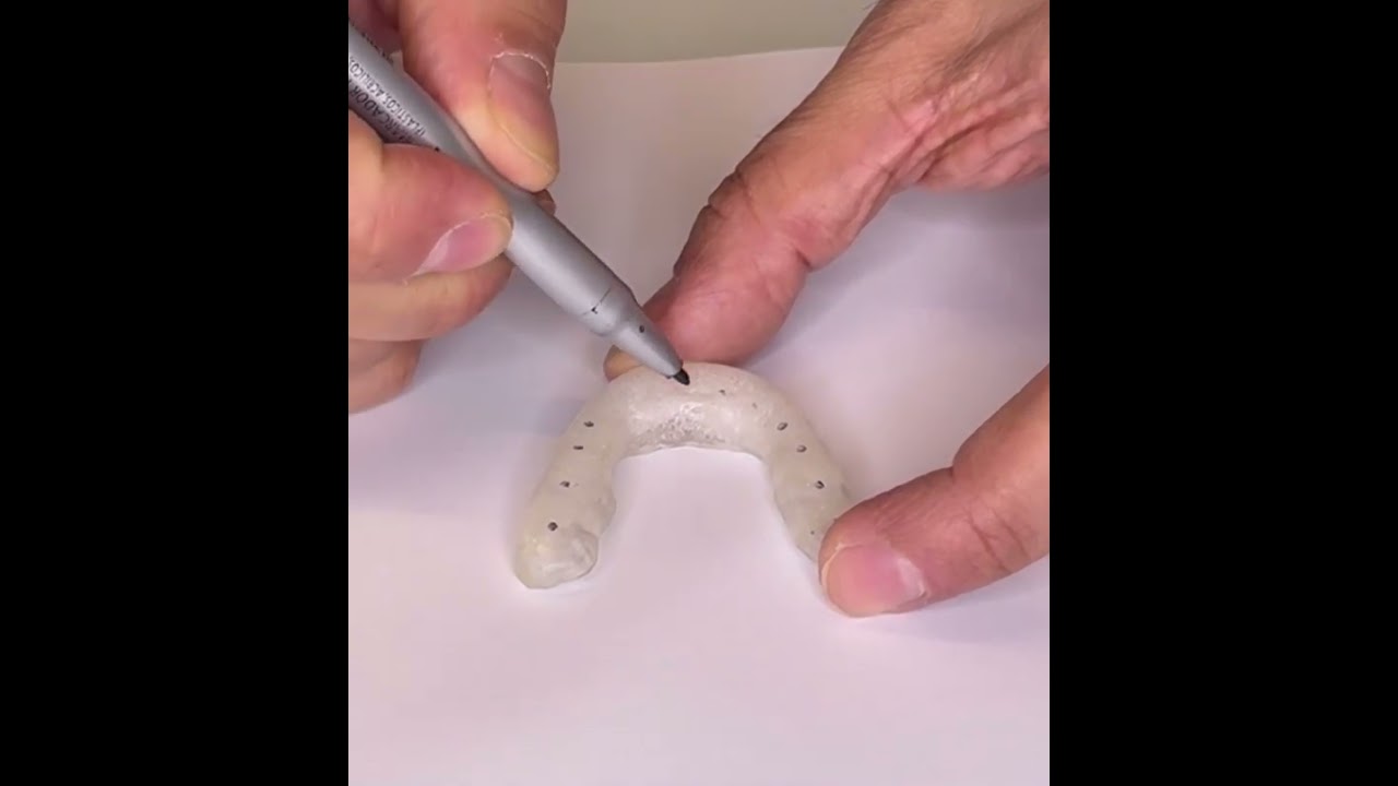 Como devem ser os contatos de uma placa Oclusal
