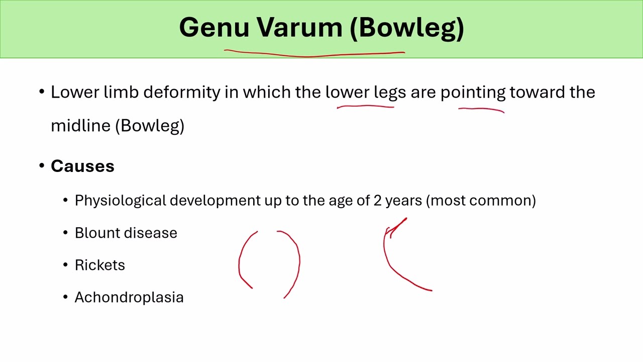 Bow Leg in Children