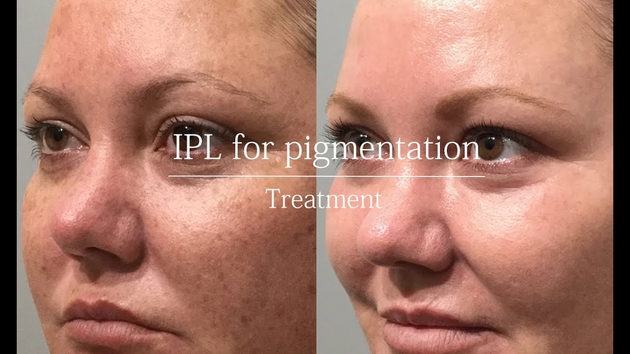 IPL for pigmentation - treatment video