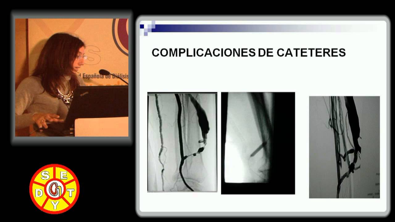 Complicaciones de los catéteres venosos. Accesos Vasculares para Hemodiálisis