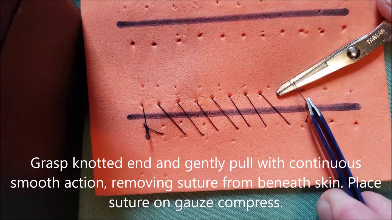 Continuous Suture Removal