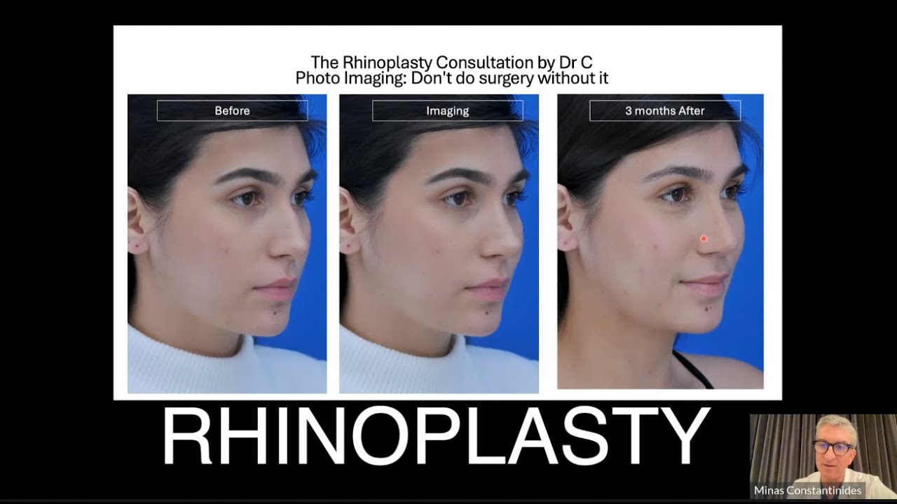 RHINOPLASTY WEBINAR WITH DR. CONSTANTINIDES #rhinoplasty