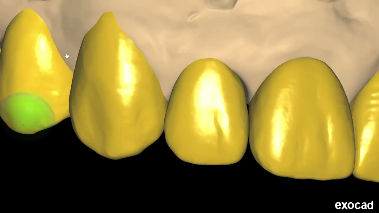 FP1 Multifunctional Guide Design UPPER JAW in EXOCAD