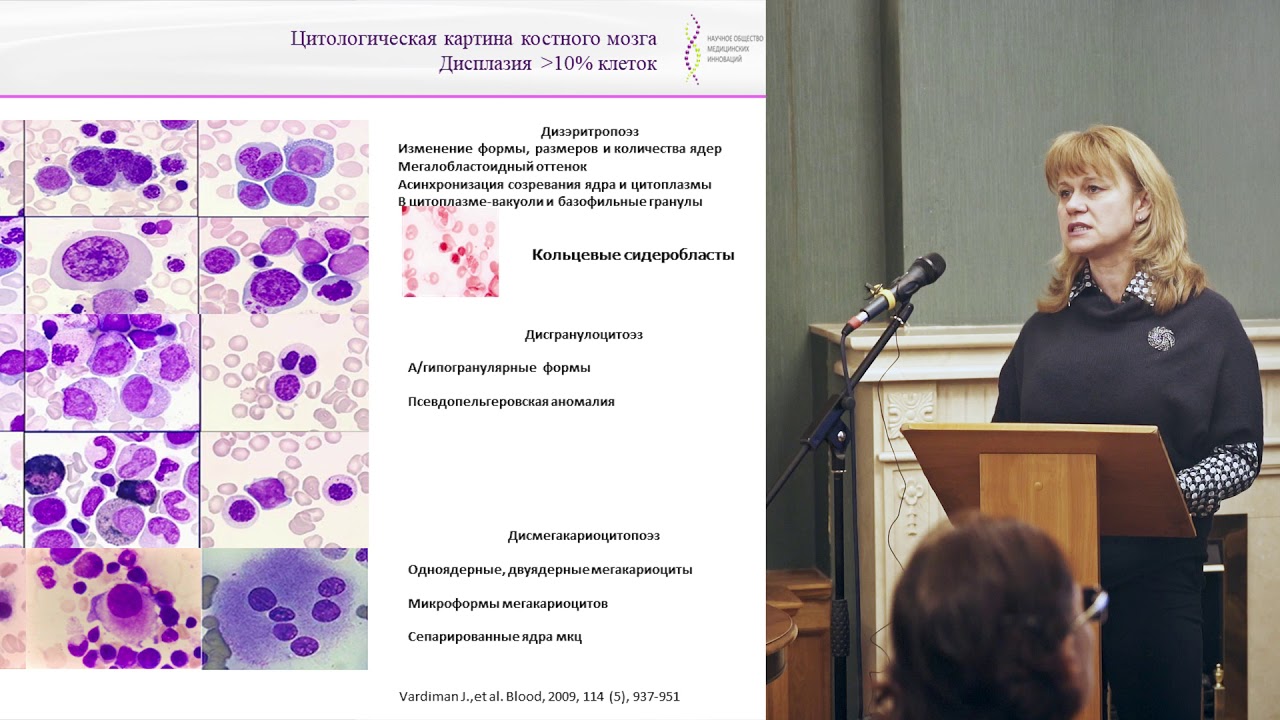 Кохно А. В. Лечение миелодиспластических синдромов