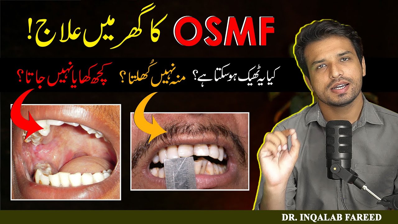 Must Watch to Get Rid of Oral Submucous Fibrosis FAST ! | @Dr. Inqalab Fareed
