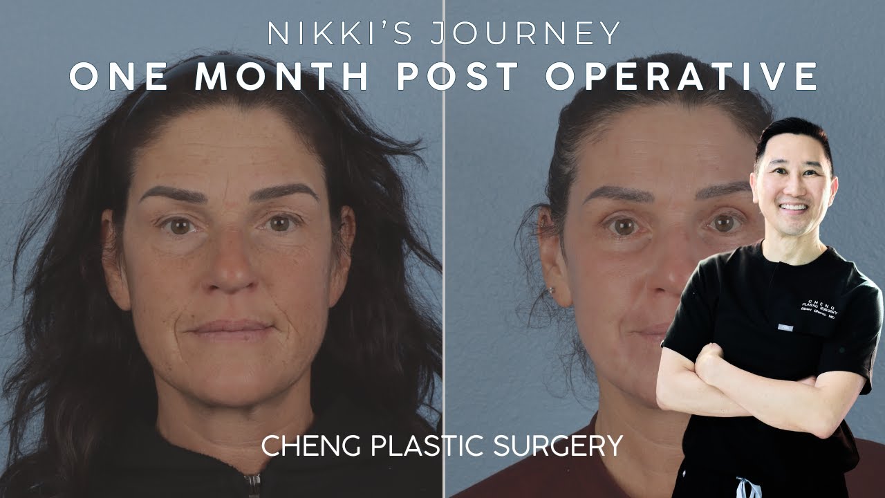 SURGICAL JOURNEY Part 5:  Nikki’s One Month Post-Op