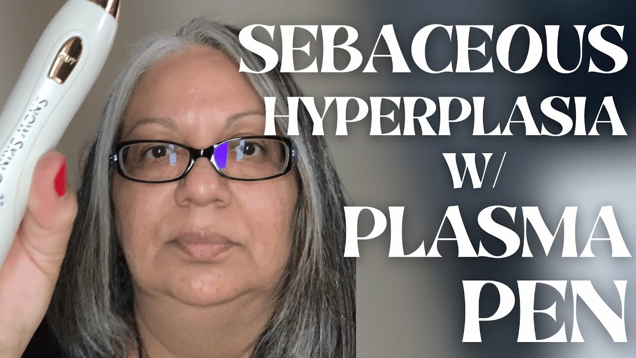 Successful Sebaceous Hyperplasia removal at-home - Customer Testimonial - Snow Skin Co