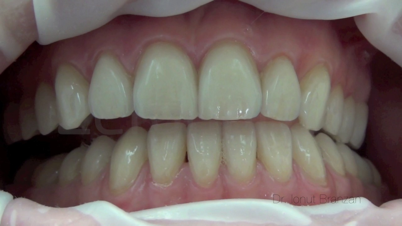 lateral and protrusive movements