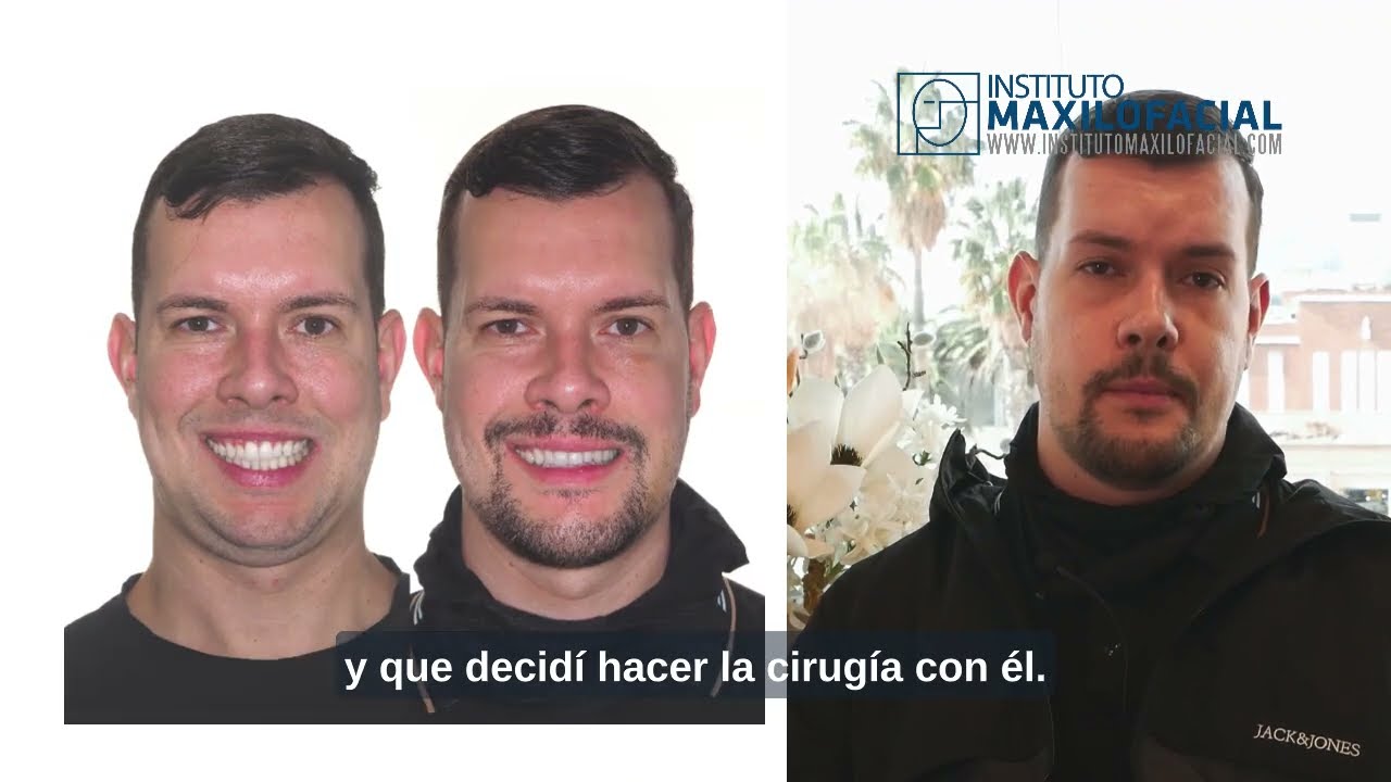 Cirug&iacute;a bimaxilar Caso #121: Kelvin- Biretrusi&oacute;n, apnea del sue&ntilde;o