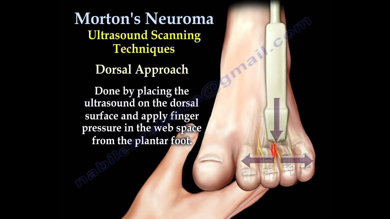 Morton's Neuroma - Everything You Need To Know - Dr. Nabil Ebraheim