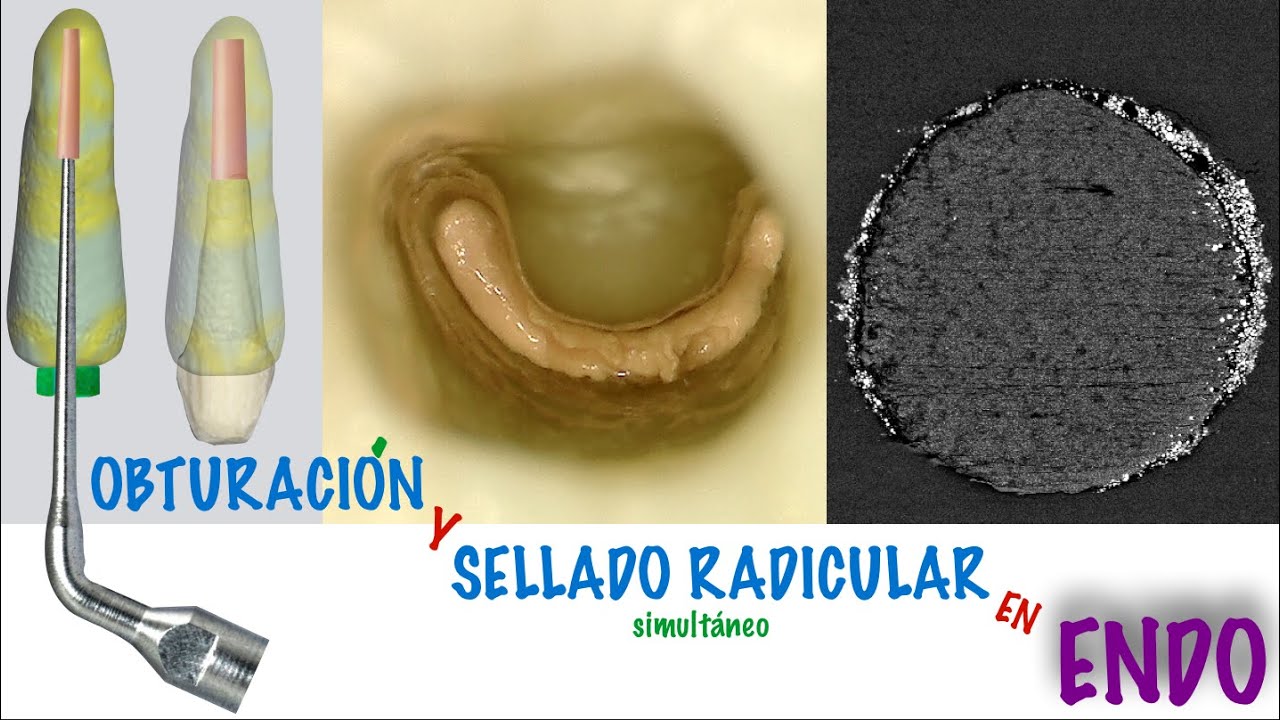 Curso: Obturación Apical y Sellado Radicular simultáneo en Endodoncia (UNPL, Argentina)
