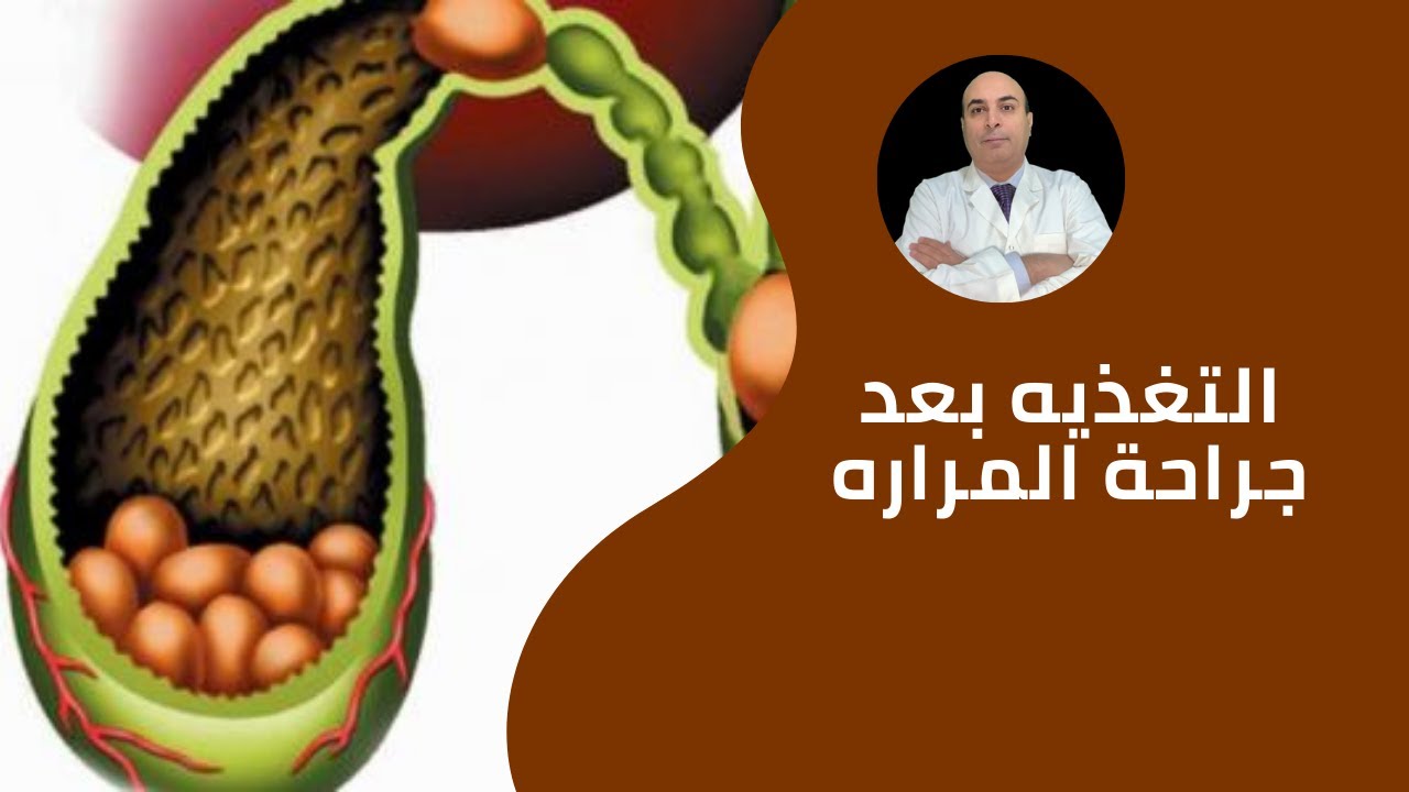 التغذية السليمه بعد استئصال المرارة