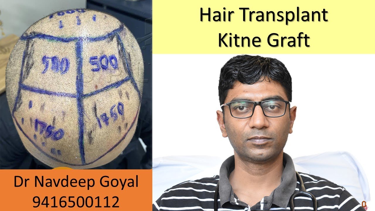How many grafts in Hair transplant | Baldness level | Norwood grading | Dr Navdeep goyal, 9416500112
