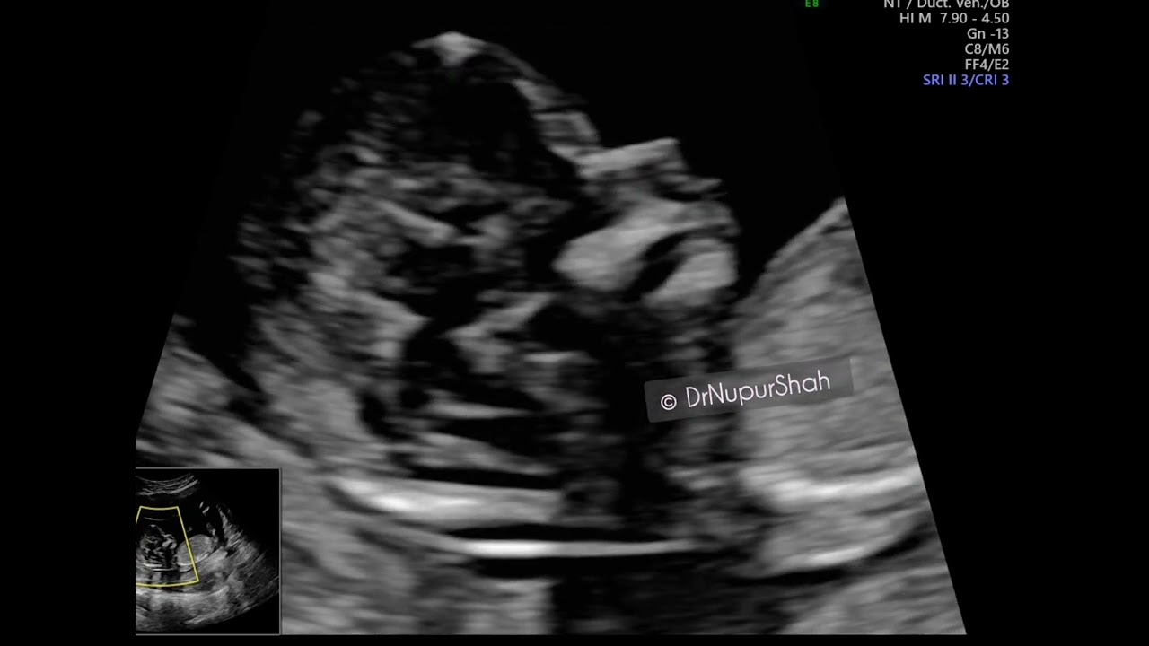 Measuring the Nuchal Translucency (NT) @drnupurshah 