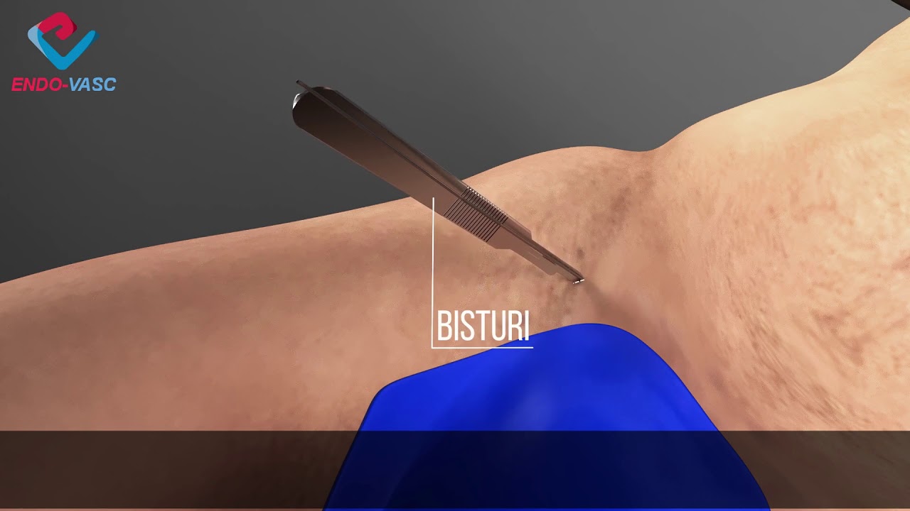 Angioplastia de artéria femoral com stent