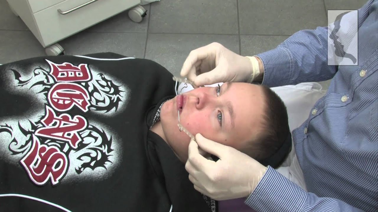 Orthodontiepraktijk Leeuwarden: De verschillende soorten beugels