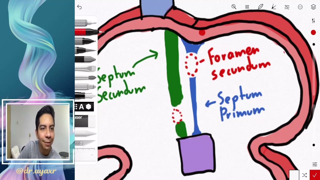 Dr. Ayax --Embriología Sistema cardiovascular--- Tabicación cardíaca 1