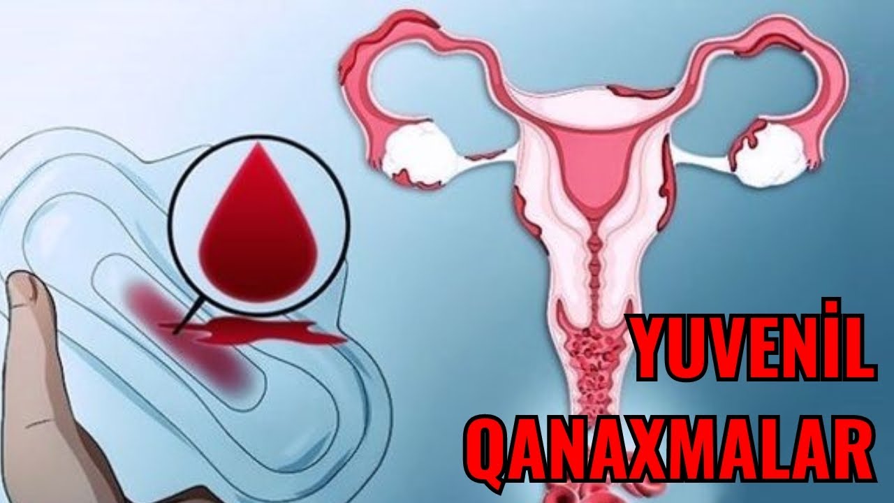 Yuvenil Qanaxmalar nədir? Buna nə səbəb olur?
