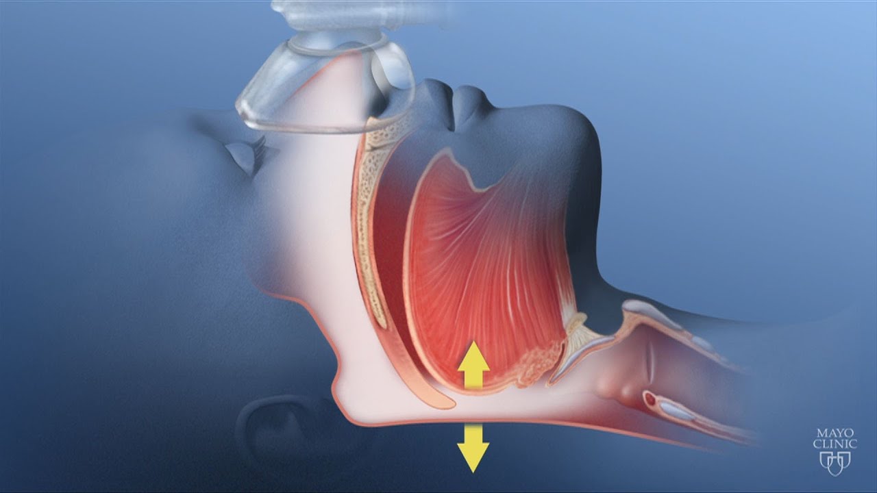 Obesity Hypoventilation Syndrome - Mayo Clinic