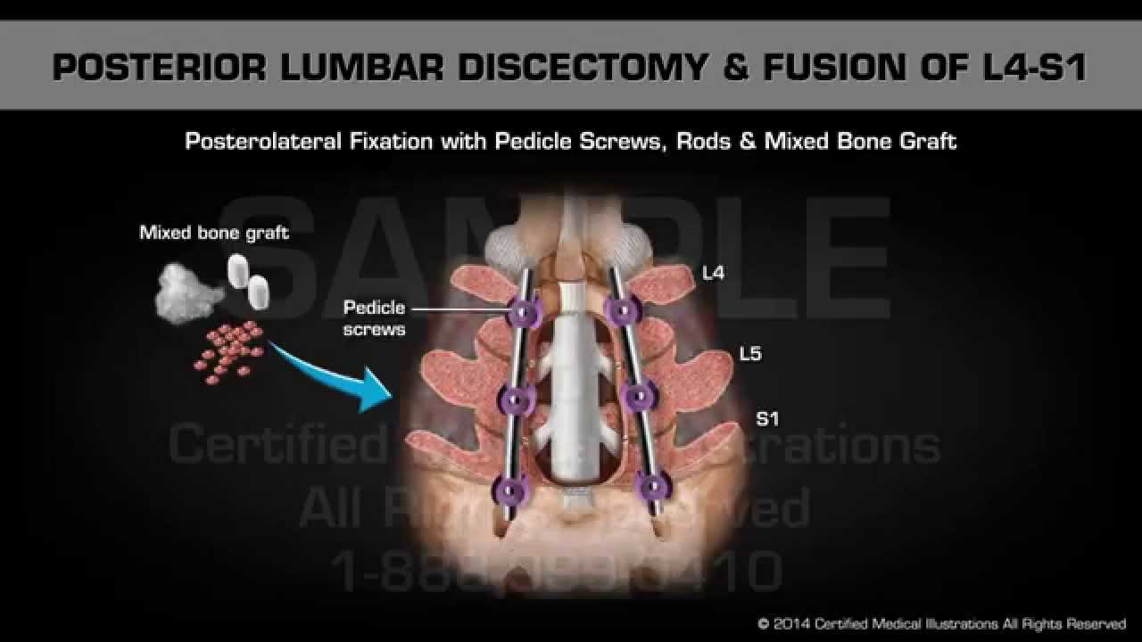 Posterior Lumbar Discectomy & Fusion of L4-S1