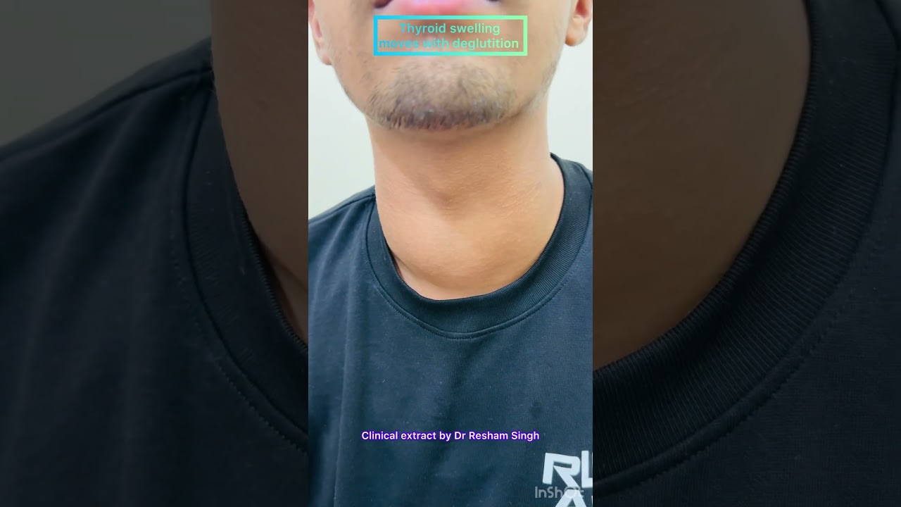 Anterior neck swelling