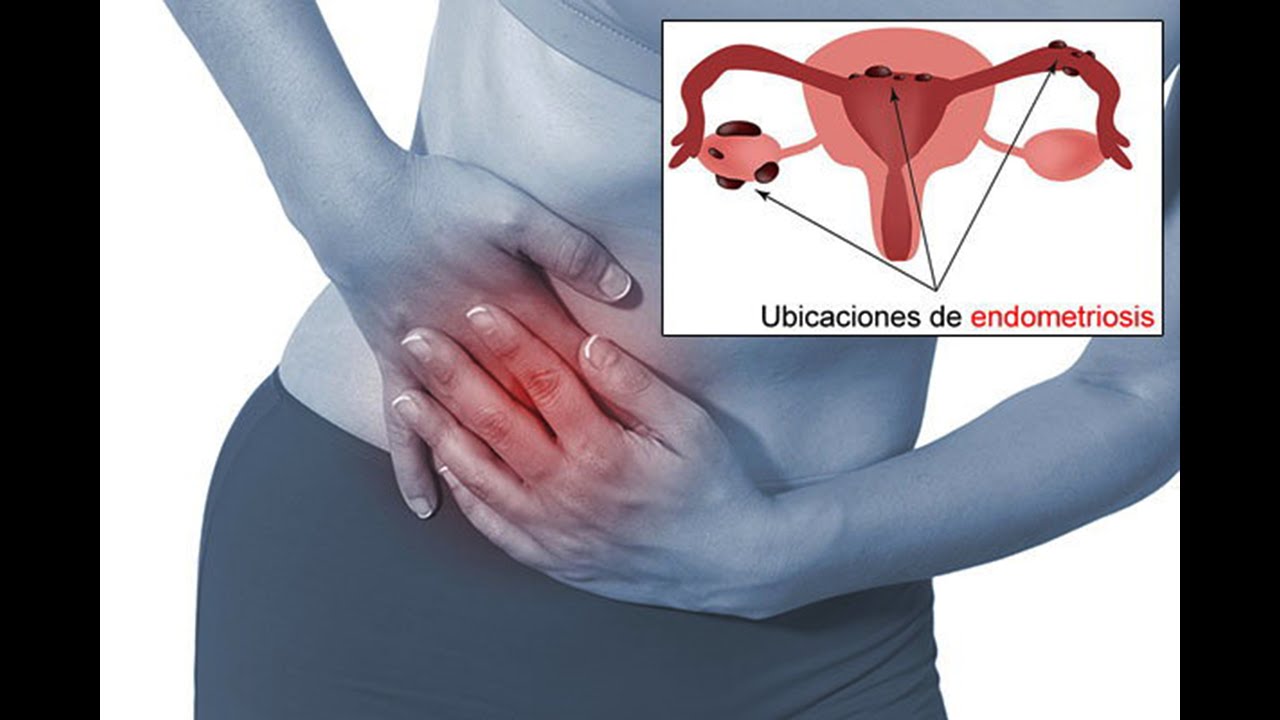Padecimiento del &uacute;tero causa dolor que puede ser incapacitante