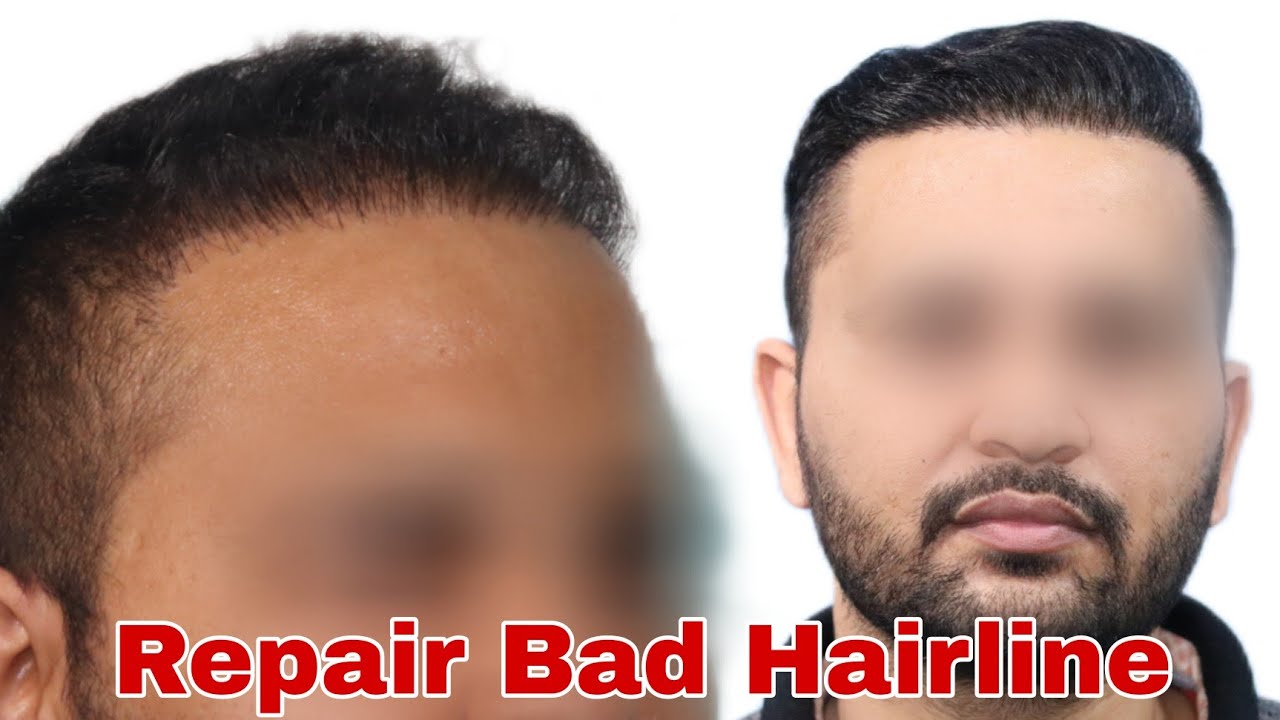 Best Hair Transplant Result || Corrective Hair Transplantation @Regrow Clinic || Repair Bad Hairline