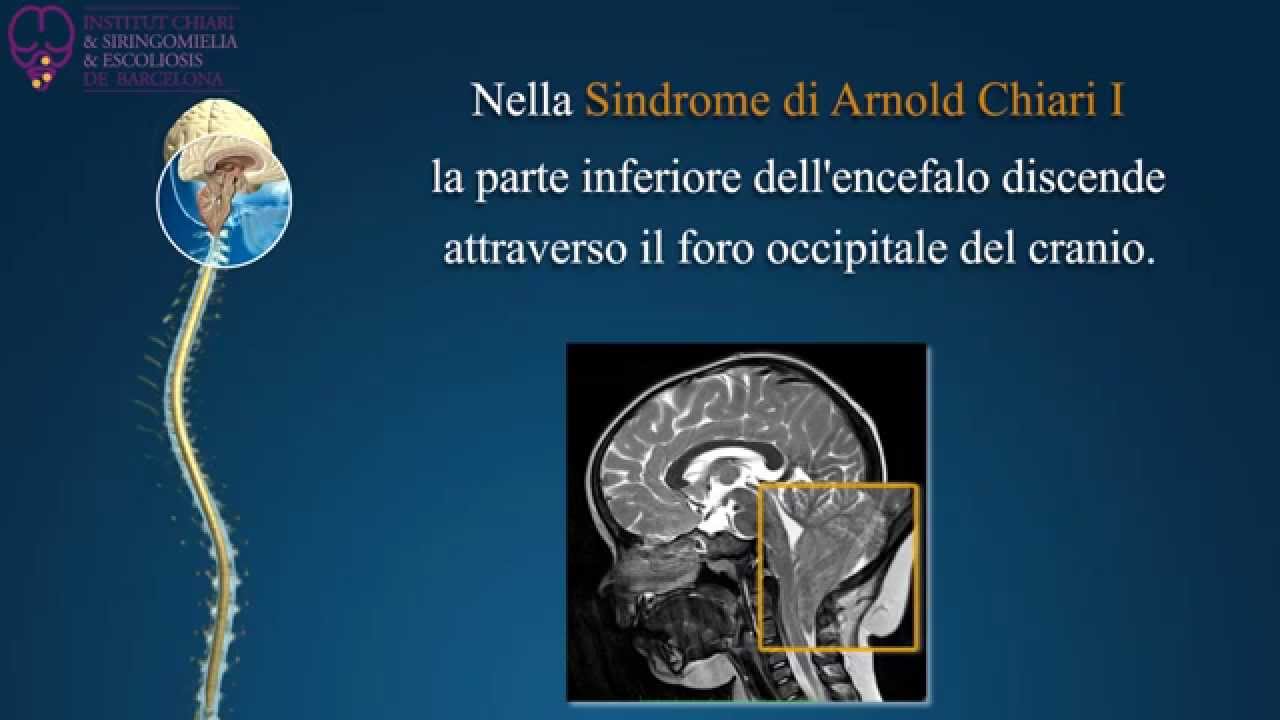 Sindrome di Arnold Chiari I, Siringomielia e Scoliosi - Institut Chiari di Barcellona