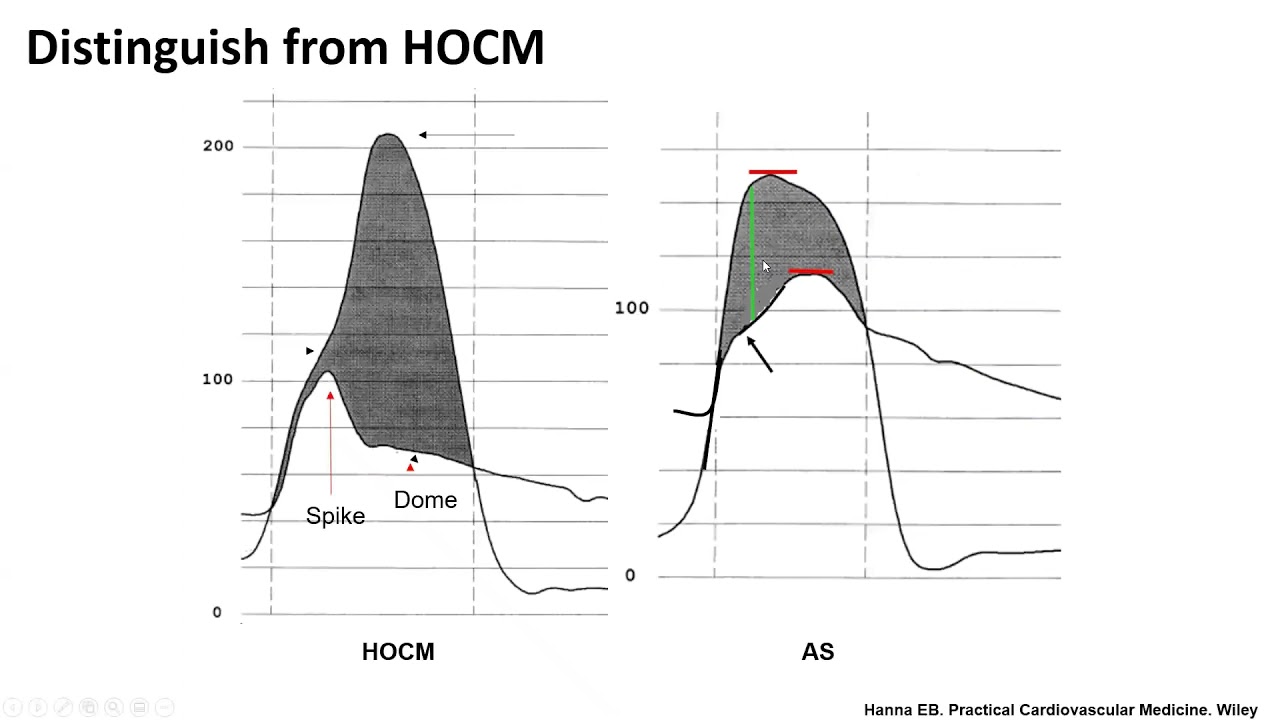 Hemodynamic assessment of aortic stenosis: technical tips- Elias Hanna, Univ of Iowa