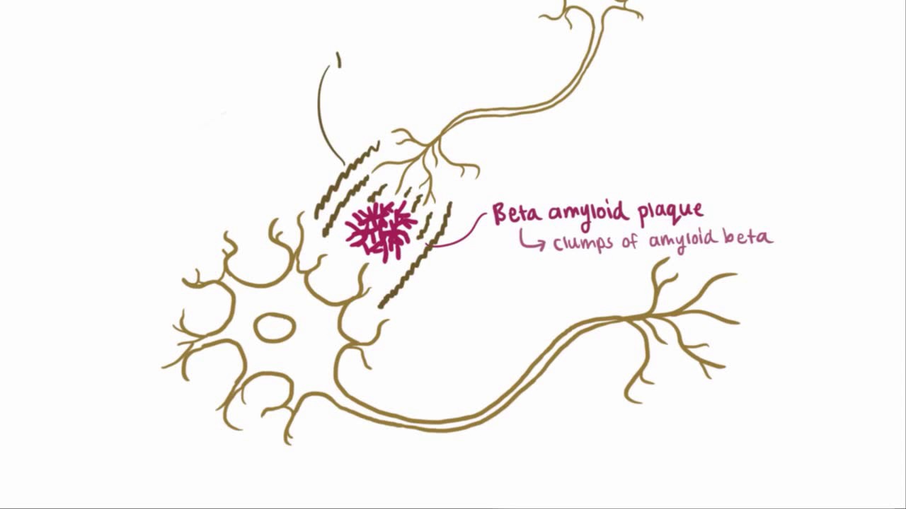 Beta amyloid and Tau proteins (transglutaminase substrates) Osmosis & Neuroscientifically Challenged